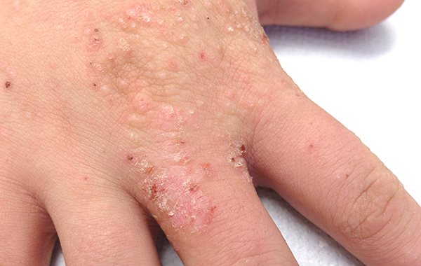 what causes dry skin on hands what causes dry skin on hands